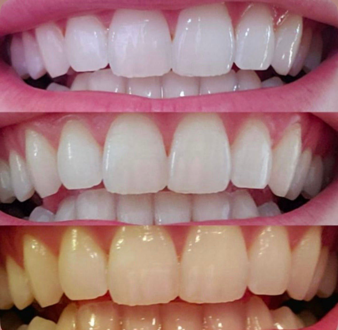 Clinically inspired teeth whitening pen